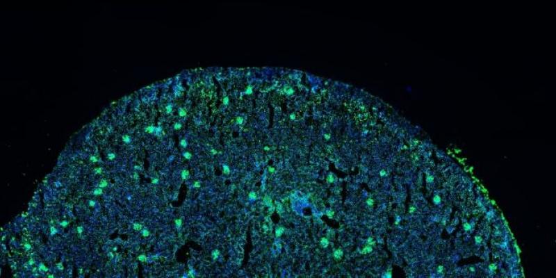 La enfermedad del lupus/ CSIC Aparición de lupus en un riñón