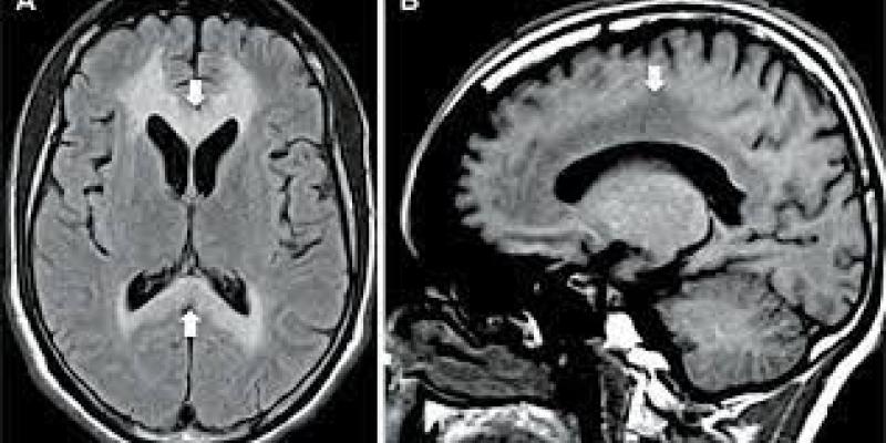 Imágenes del cerebro / La mañana digital ¿Qué es la enfermedad de Marchiafava-Bignami?