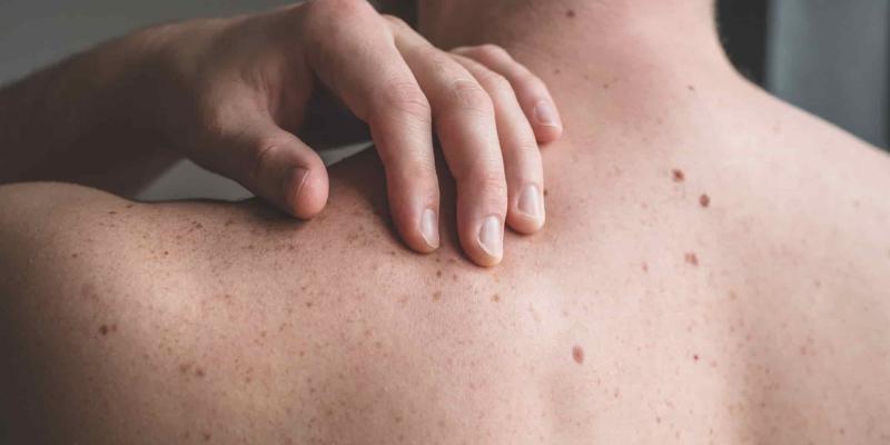 El melanoma destaca en las zonas con más dinero