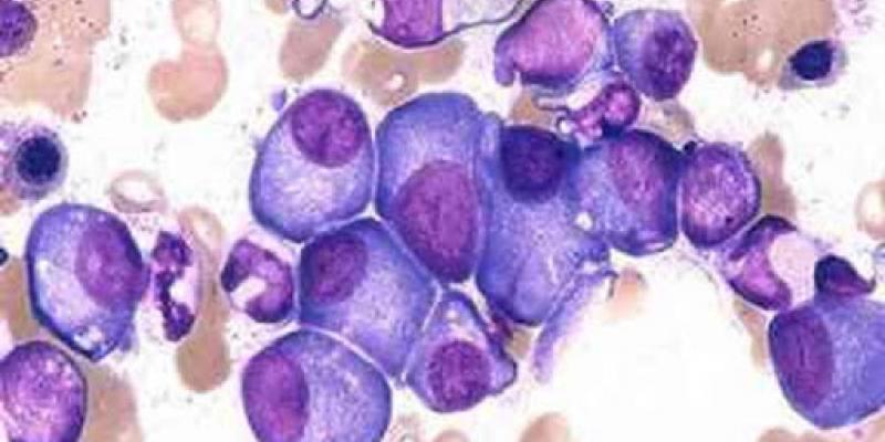 'Lo que no ves' muestra los desafíos que afrontan a diario los pacientes con Mieloma Múltiple 'Lo que no ves', una exposición para visibilizar el mieloma múltiple