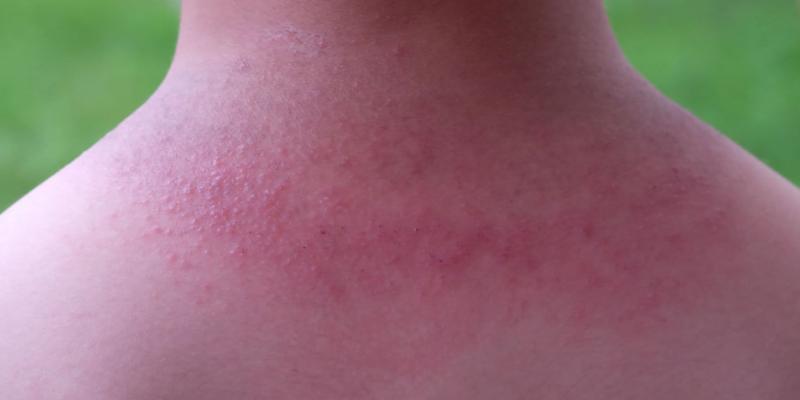 Imagen de un sarpullido/Healthily Sarpullidos y ampollas por el calor