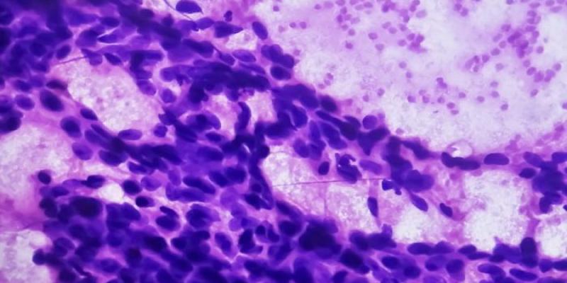 Tumor cáncer de mama | Foto del CSIC Un tumor mamario que muestra carcinoma ductal | Foto del CSIC