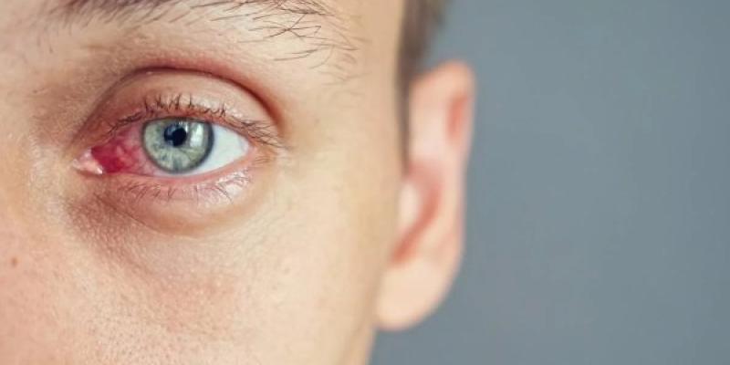 El ojo seco afecta a muchos españoles El ojo seco, una afección común en España