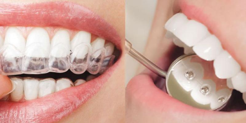 La ortodoncia invisible se ha convertido en la alternativa a los brackets 