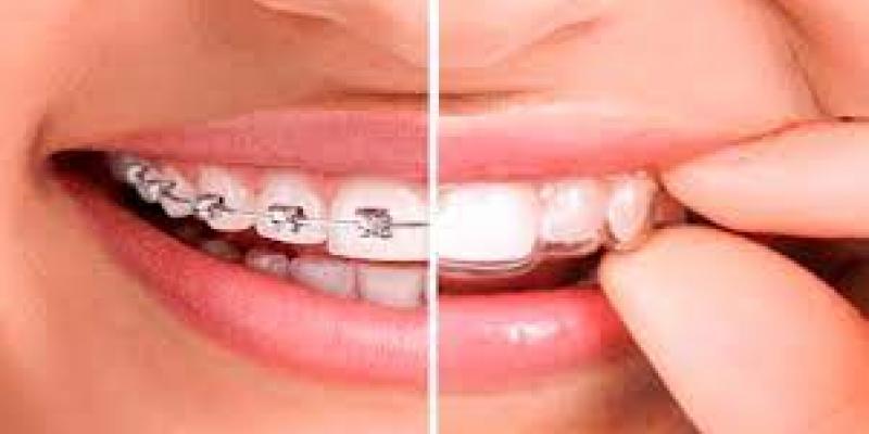 La ortodoncia invisible es cada vez más común en toda la población Brackets y alineadores invisibles/Dentaltix