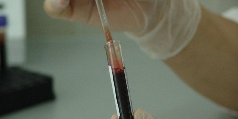 Análisis en el laboratorio del sangre de pacientes con sida