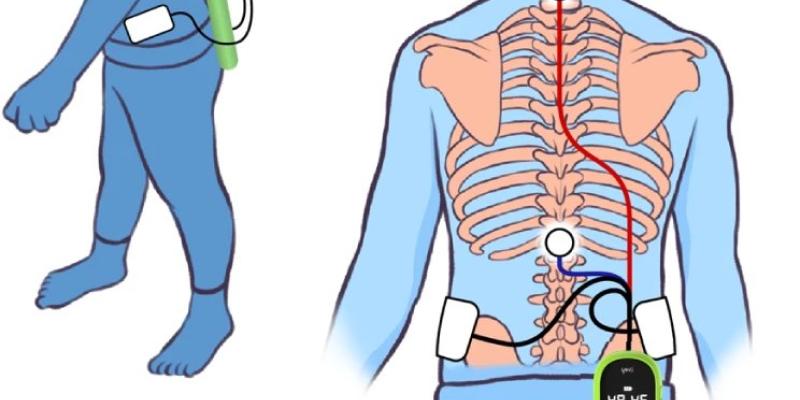 Innovación para contrarrestar la parálisis cerebral - Nature Comunications Soluciones para la parálisis cerebral