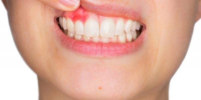 Periodontitis, la enfermedad bucal que incrementa los riesgo del coronavirus Cómo tratar la piorrea, la enfermedad que incrementa los riesgos del coronavirus