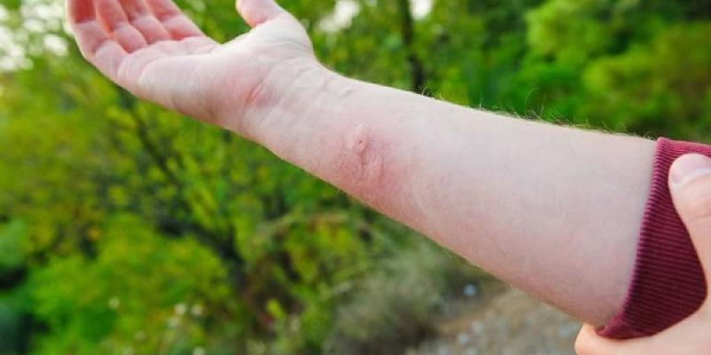 Picadura de avispa asiática