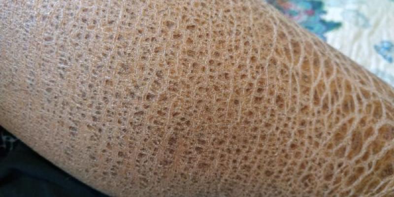Piel de pez, una ictiosis extrema. Así se ve la piel de pez o ictiosis