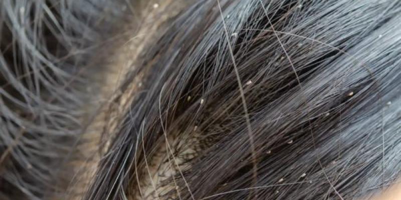 Los mejores trucos para prevenir los piojos / El Español Los mejores trucos para prevenir los piojos.