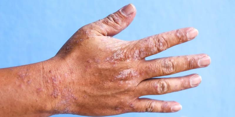 Así se ve la porfiria de Günther - iStock Una mano afecta por porfiria de Günther