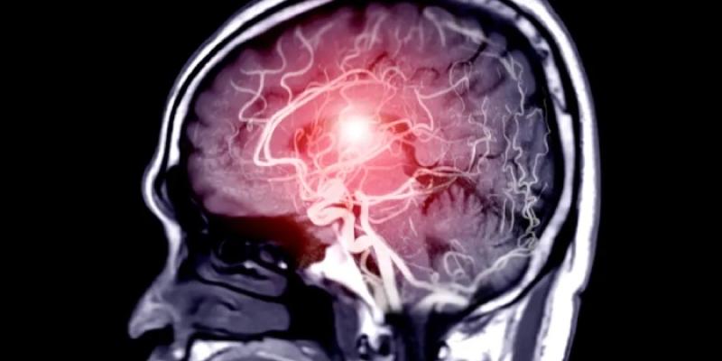 Epilepsia - Foto: Getty Images Una resonancia magnética de un cerebro humano.