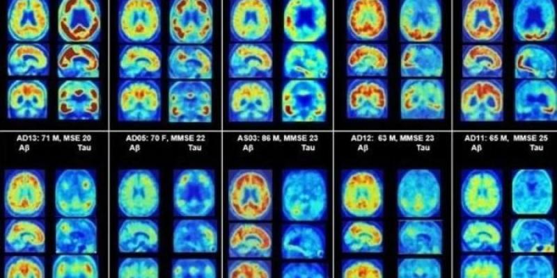 Probióticos - Foto: Europa Press Imágenes de pacientes con Alzheimer