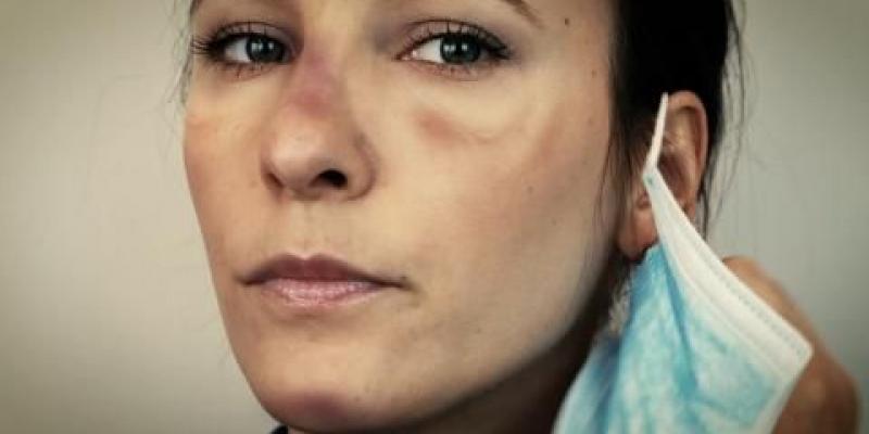 Médicos y sanitarios de todo el mundo nos han mostrado a través de las redes las huellas que dejan las mascarillas de la piel. (Fotos: Facebook/Martina Benedetti/Nicola Sgarbi)