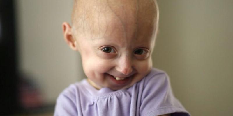 Imagen de una niña con proferia/CNIC La progeria es una enfermedad rara
