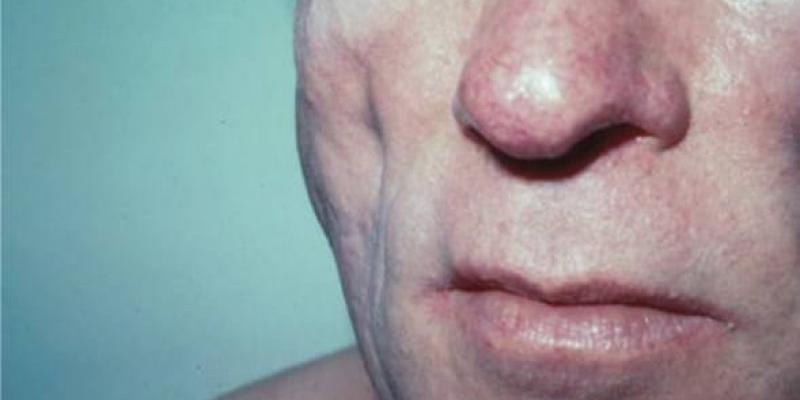 Ejemplo de lipodistrofia/ Lineaysalud Lipodistrofia/ Lineaysalud