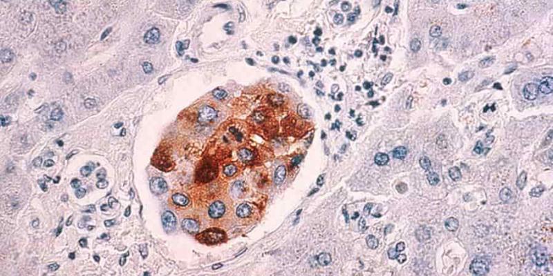Imagen de un tumor/National Cancer Institute Los expertos alertan de algunos efectos de la quimioterapia