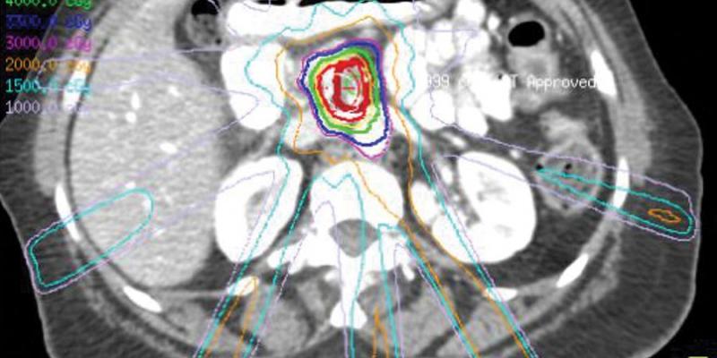 Los tratamientos con radioterapia curan entre el 40 y el 90 % de los tumores de cabeza y cuello Destacan la efectividad de la radioterapia que cura entre el 40 y el 90% de los tumores de cabeza