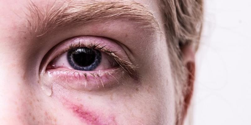 Adolescente llorando con una marca debajo del ojo por un golpe / Pixabay