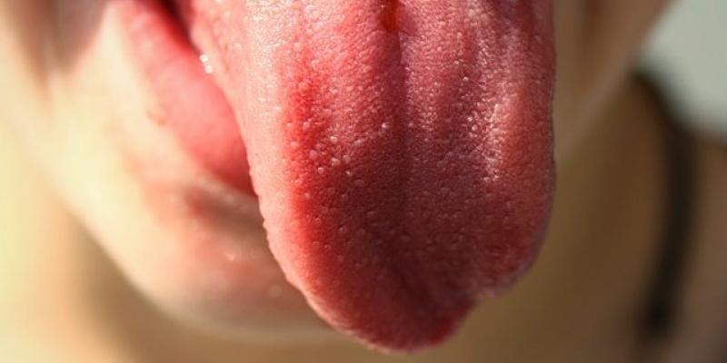 Imagen de una lengua/Clínica DentalIbaidondo Qué dice la lengua sobre nuestra salud