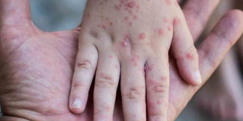 Crece la mortalidad por sarampión entre los niños Las muertes por sarampión crecieron un 50 % entre 2016 y 2019