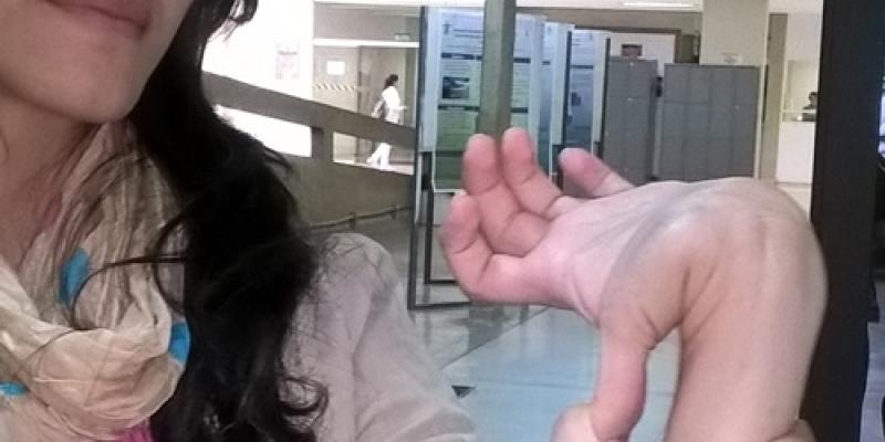 Día Internacional del Síndrome de Ehlers-Danlos / revistavisaohospitalar Mujer con el Síndrome de Ehlers-Danlos