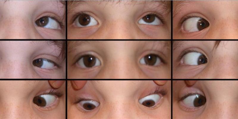 Imagen de un síntoma ocular del Síndrome de Aarskog/ScienceDirect Síndrome de Aarskog