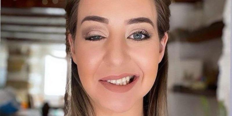Imagen de una chica con síndrome de Ramsay Hunt/BBC Cómo es vivir con el síndrome de Ramsay Hunt, la enfermedad de Bieber