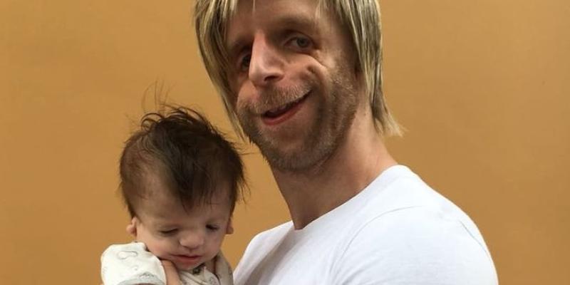 Jono Lancaster, influencer con Treacher Collins - Instagram Pacientes con el síndrome de Treacher Collins