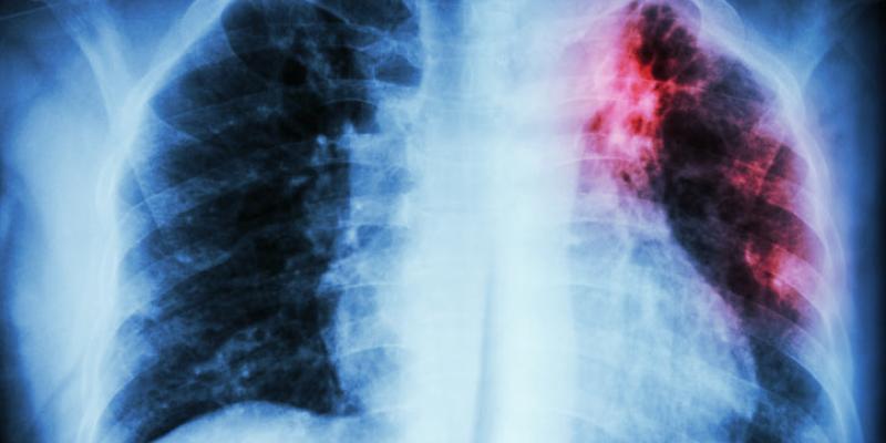 Hoy se conmemora el Día Mundial de la Tuberculosis, en tiempos de Covid-19 Día Mundial de la Tuberculosis
