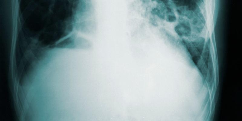 Un tratamiento más eficaz contra la tuberculosis. Imagen: @cdc en Unsplash Hallan un tratamiento más eficaz contra la tuberculosis. Foto: @cdc en Unsplash