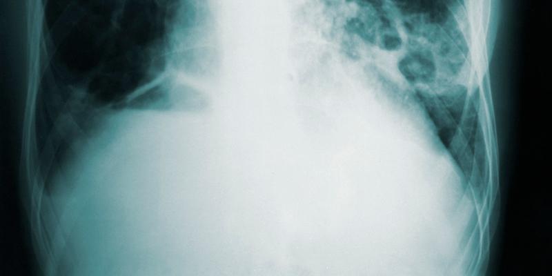 Hallan un tratamiento más eficaz contra la tuberculosis. Foto: @cdc en Unsplash