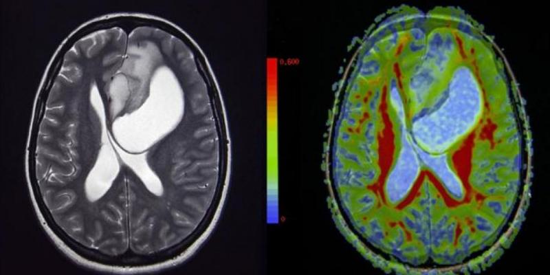 Imagen de una radiografía de un tumor cerebral/La Vanguardia Un virus del catarro podría luchar contra los cánceres letales en niños