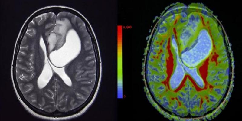 Un virus del catarro podría luchar contra los cánceres letales en niños