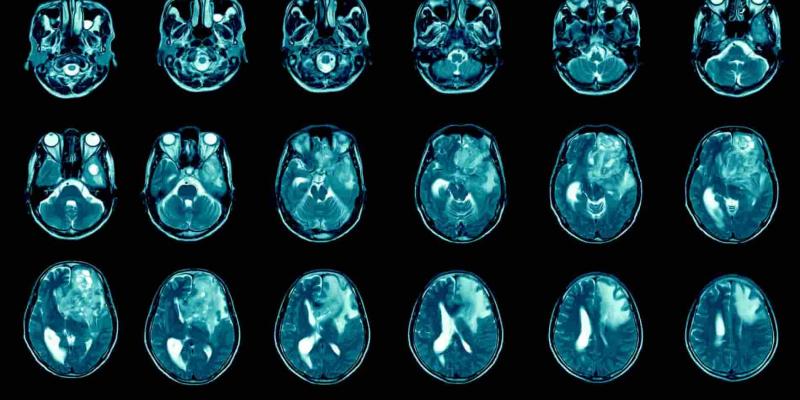 Imagen de una radiografía del cerebro/20Minutos Nuevo fármaco para los tumores sólidos