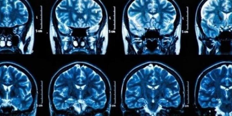 Crean una 'nariz artificial' capaz de identificar el tejido maligno durante las operaciones de tumores. tumores cerebrales