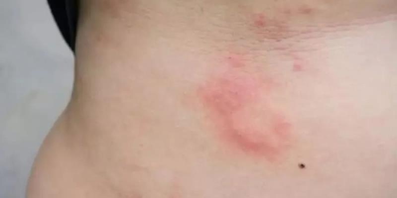 Las personas alérgicas al estrés desarrollan ronchas o habones en la piel como respuesta a dichas situaciones - Foto:EP Persona con alergia en la piel