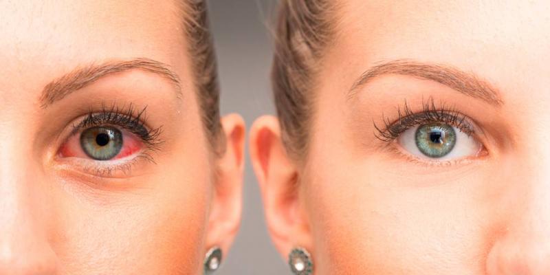 Uveítis / Clínica Oftalmológica González Costea Imagen del enrojecimiento de un ojo frente a uno sano