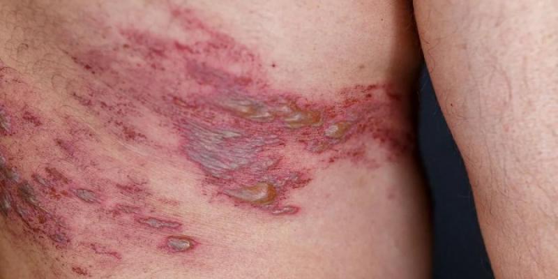 herpes zóster - Foto: Felix Fernandez Gonzalez herpes zóster