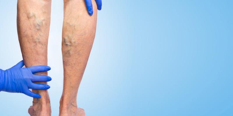 Las varices tienen una mayor incidencia en mujeres - Hospital Ruber Varices en las piernas