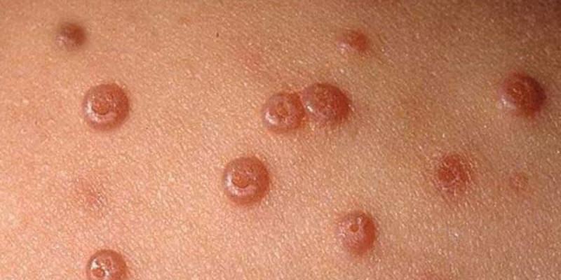 Imagen de verrugas/Clínica Dermatológica Internacional Verrugas y lesiones cutáneas