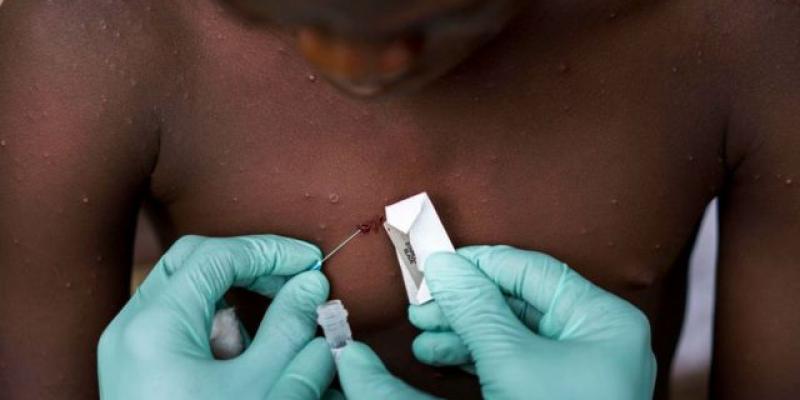 Imagen de un médico inyectando una vacuna/BBC Aparece la vacuna contra la viruela del mono