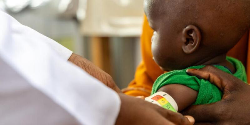 Hambre - Foto: World Vision Niño con desnutrición infantil