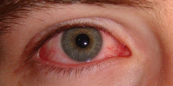 Conjuntivitis