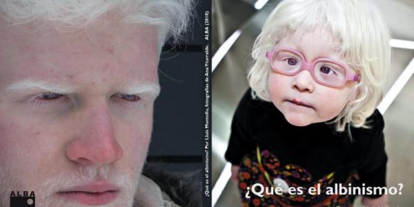 El albinismo afecta a 3.500 personas aproximadamente en España