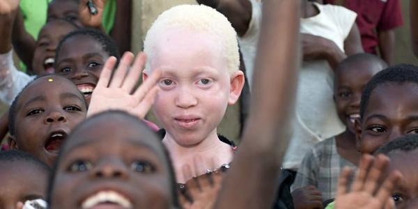 Albinos en África: brujería y negocio