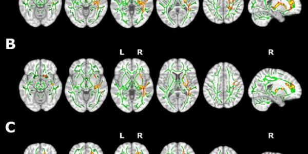 El insomnio provoca cambios cerebrales relacionados con etapas tempranas del alzhéimer.