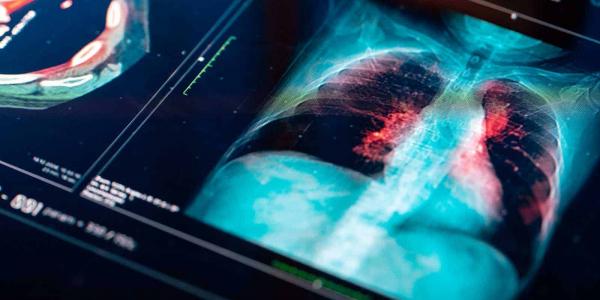 Una nueva terapia que erradica un gran porcentaje de casos de cáncer de pulmón