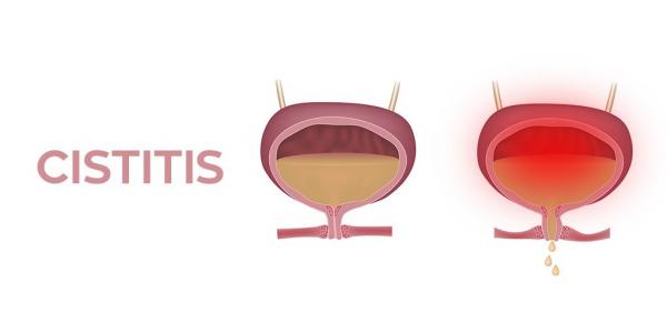 vejiga con cistitis y vejiga sin la infección